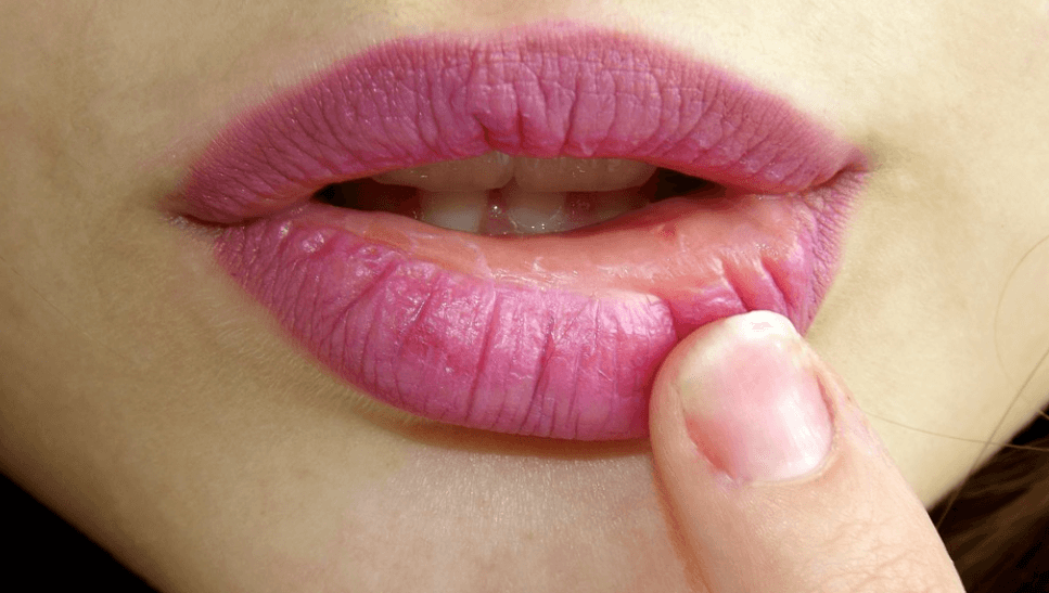 Heb Jij Ook Altijd Zo N Last Van Droge Gebarsten Lippen In De Winter Hier Komt Het Door Tips En Weetjes